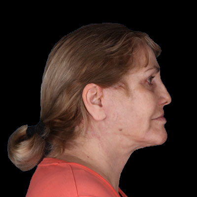 Neck Lift Before & After Patient #1895