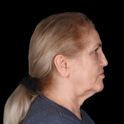 Neck Lift Before & After Patient #1895
