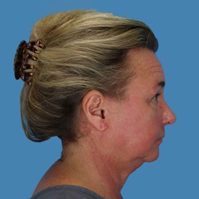 Neck Lift Before & After Patient #1878