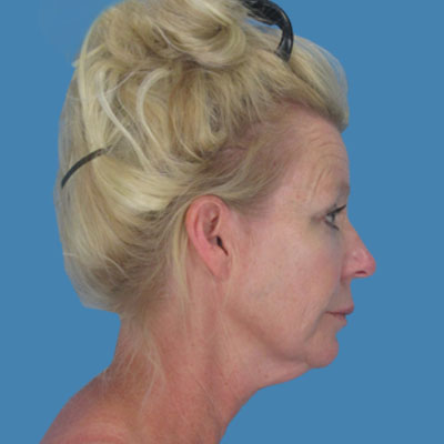 Neck Lift Before & After Patient #1888