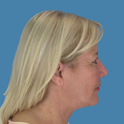 Neck Lift Before & After Patient #1900
