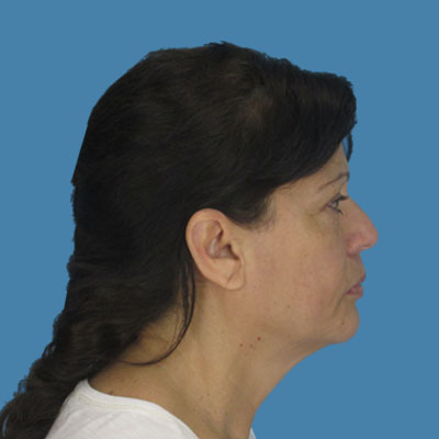 Neck Lift Before & After Patient #1903