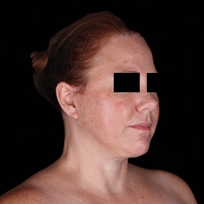 Facelift Before & After Patient #1913