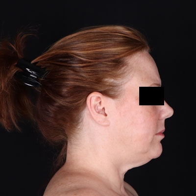 Neck Lift Before & After Patient #1866