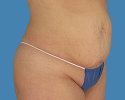 LipoTuck Before & After Patient #1971