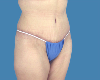 Tummy Tuck Before & After Patient #2001